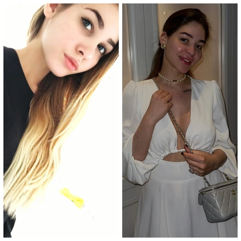 Анастасия Цапок до и после плaстики