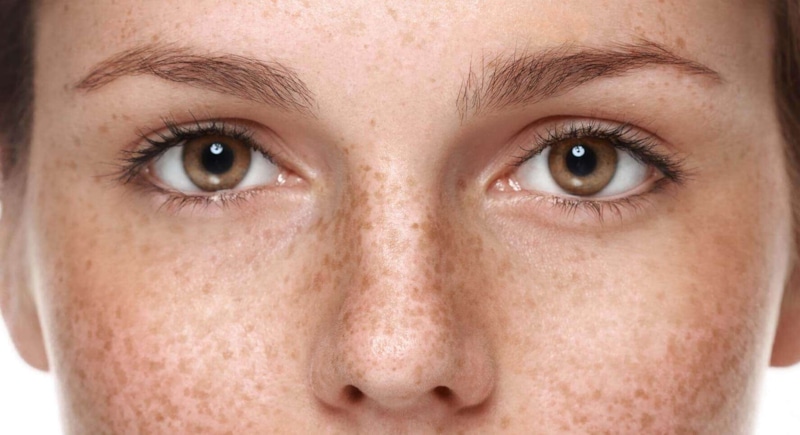 Пигментные пятна: следы солнца на коже Пигментные пятна: следы солнца на коже