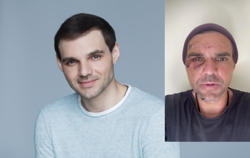 Артем Алексеев после аварии рискнул с нетрадиционной медициной