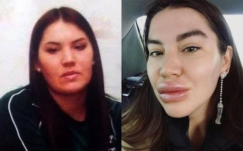 Рада Русских до и после пластики