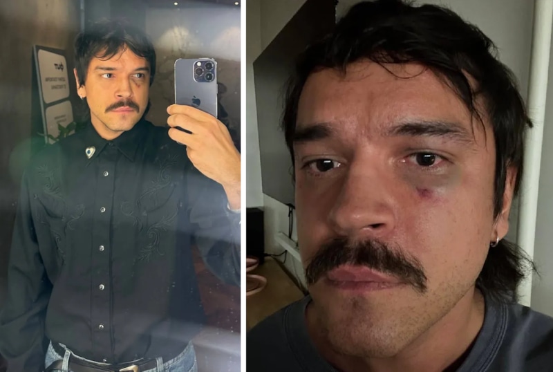 Никита Калмыков показал разбитое лицо после нападения Никита Калмыков показал разбитое лицо после нападения