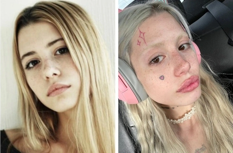 Анна Михеева до и после пластики