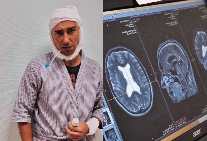 Операция на мозге стала единственным шансом на спасение Гарри Топора