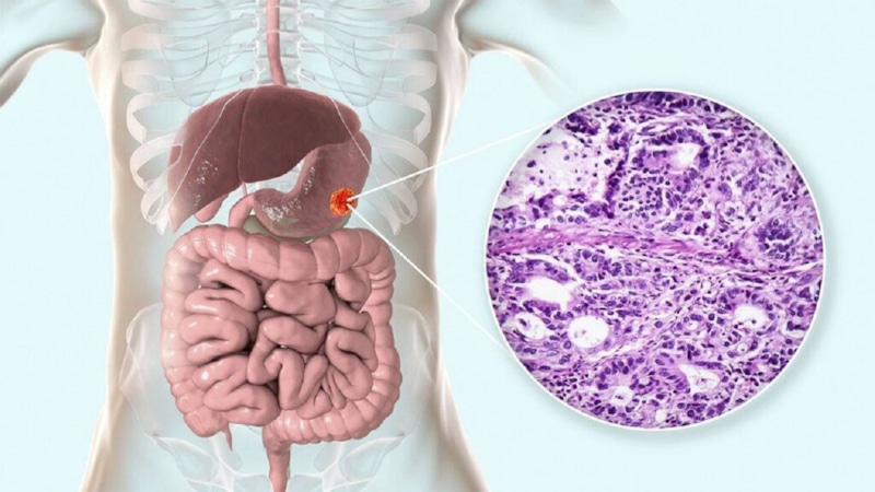 Рак кишечника: ранние признаки болезни