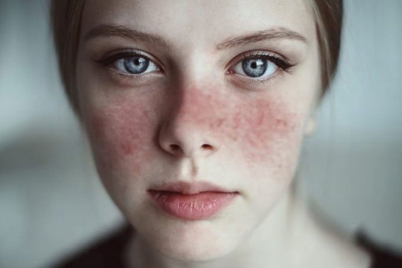 Системная красная волчанка: сыпь-бабочка на лице Системная красная волчанка: сыпь-бабочка на лице