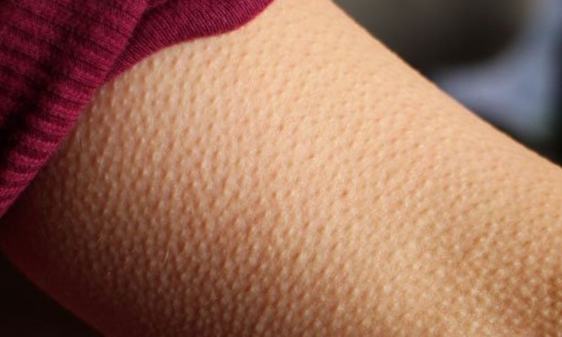 Мурашки на коже: древний рефлекс