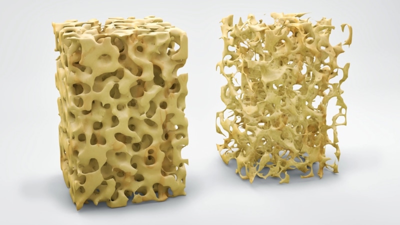 Остеопороз в костях: скрытая потеря прочности