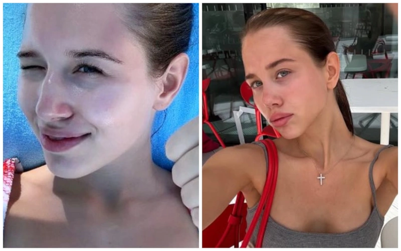 Аврора Киба до и после пластики