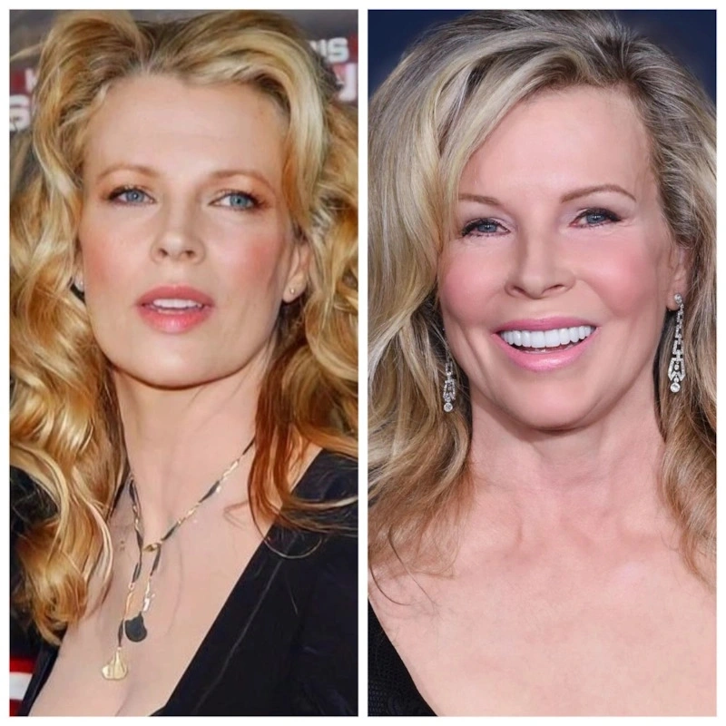 Ким Бейсингер до и после пластики