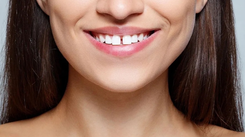 Диастема: щель между зубами