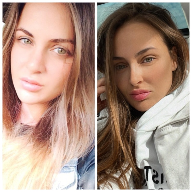 Ангелина Дубровская до и после пластики