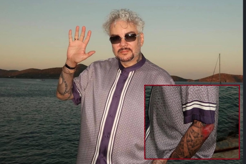 Киркоров впервые показал пострадавшую руку Киркоров впервые показал пострадавшую руку