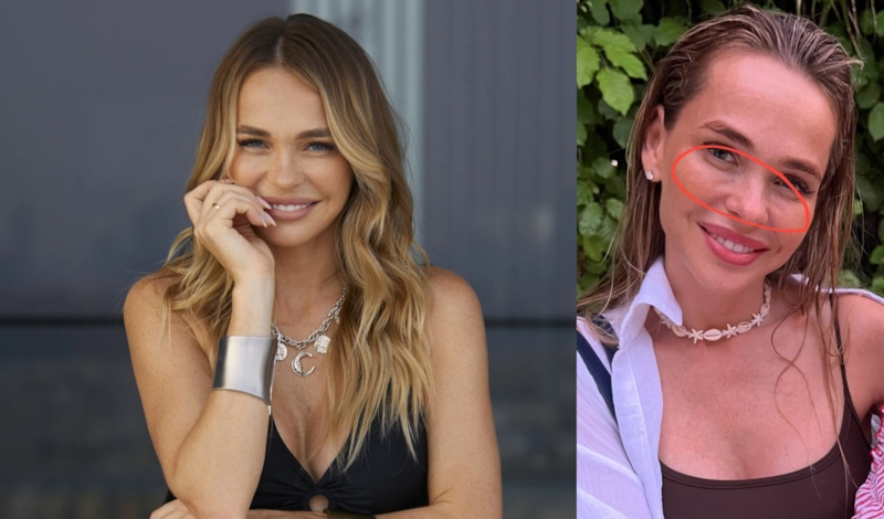 Анна Хилькевич показала последствия неудачной инъекции Анна Хилькевич показала последствия неудачной инъекции