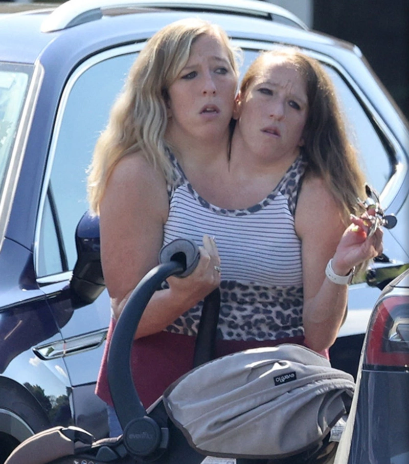 Сестры Хенсел родили ребенка