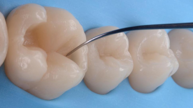 Треснувшая пломба: скрытая угроза