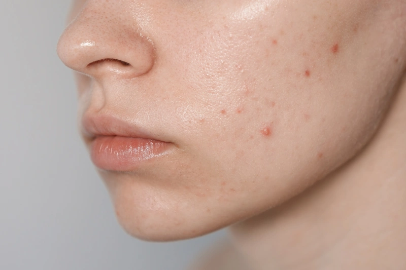 Акне и еда: неожиданная связь Акне и еда: неожиданная связь