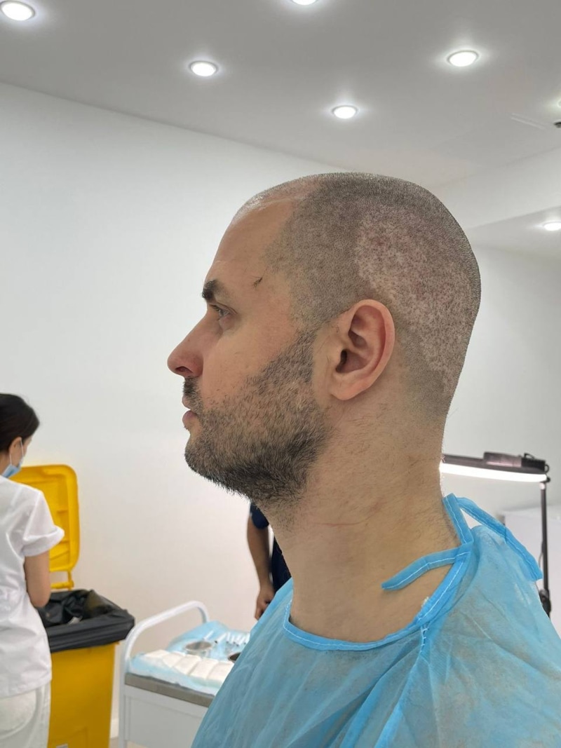 Сергей Савин после пересадки волос