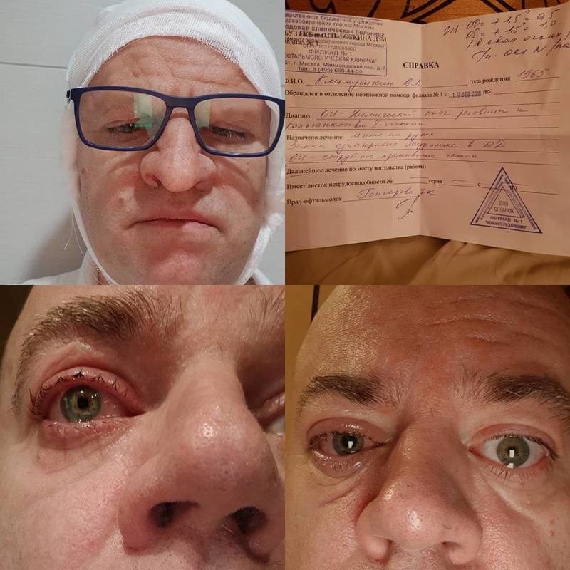 Ожог роговицы глаза Алексея Климушкина