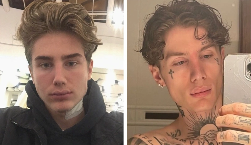 Олег Moneyken до и после пластики