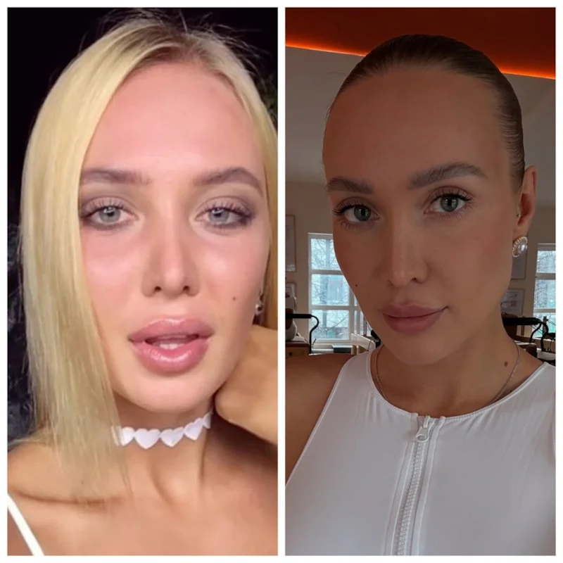 Лиза Полыгалова до и после пластики
